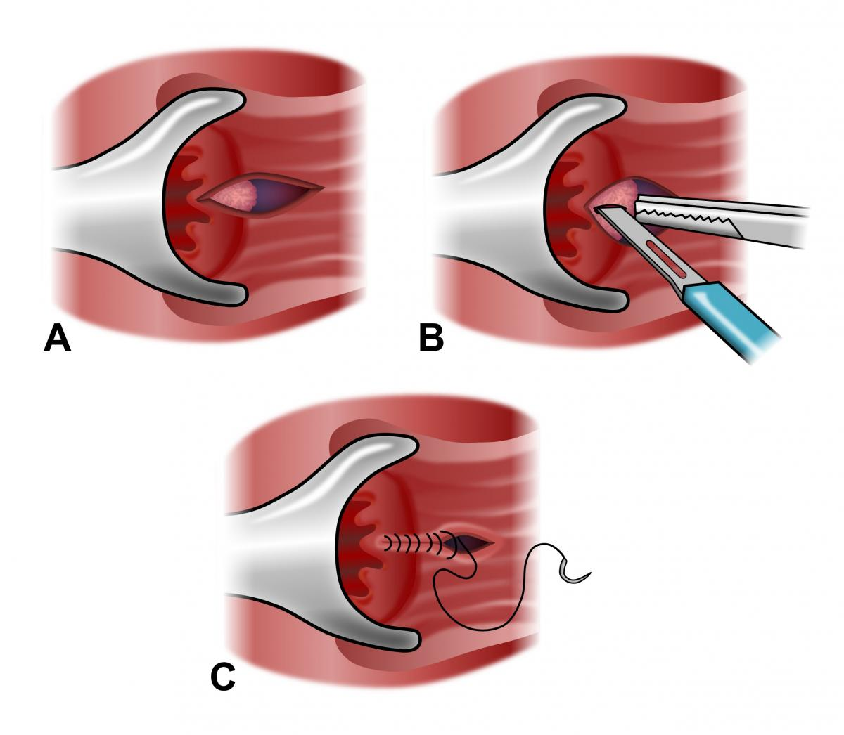 Операция по иссечению анальной трещины - методы удаления анальной трещин